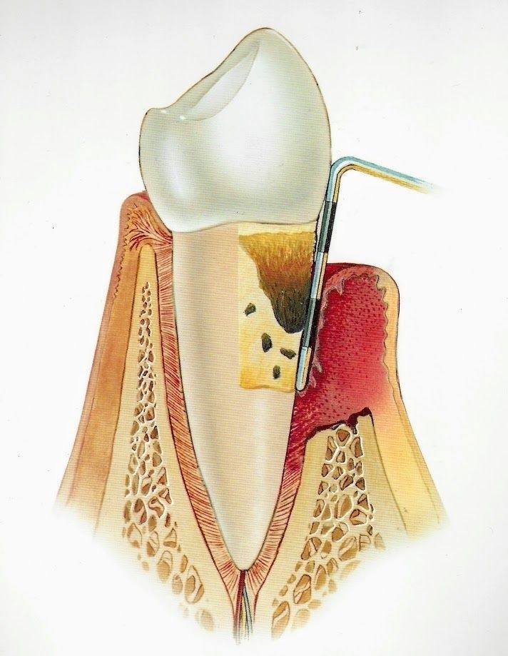 Image of Advanced Periodontitis