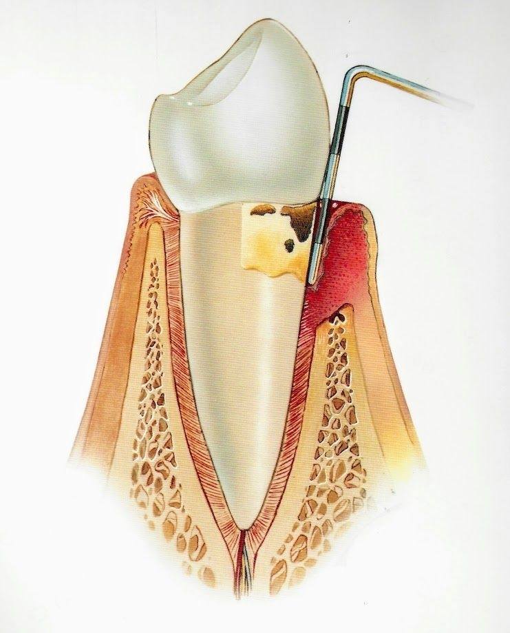 Image of Moderate Periodontitis